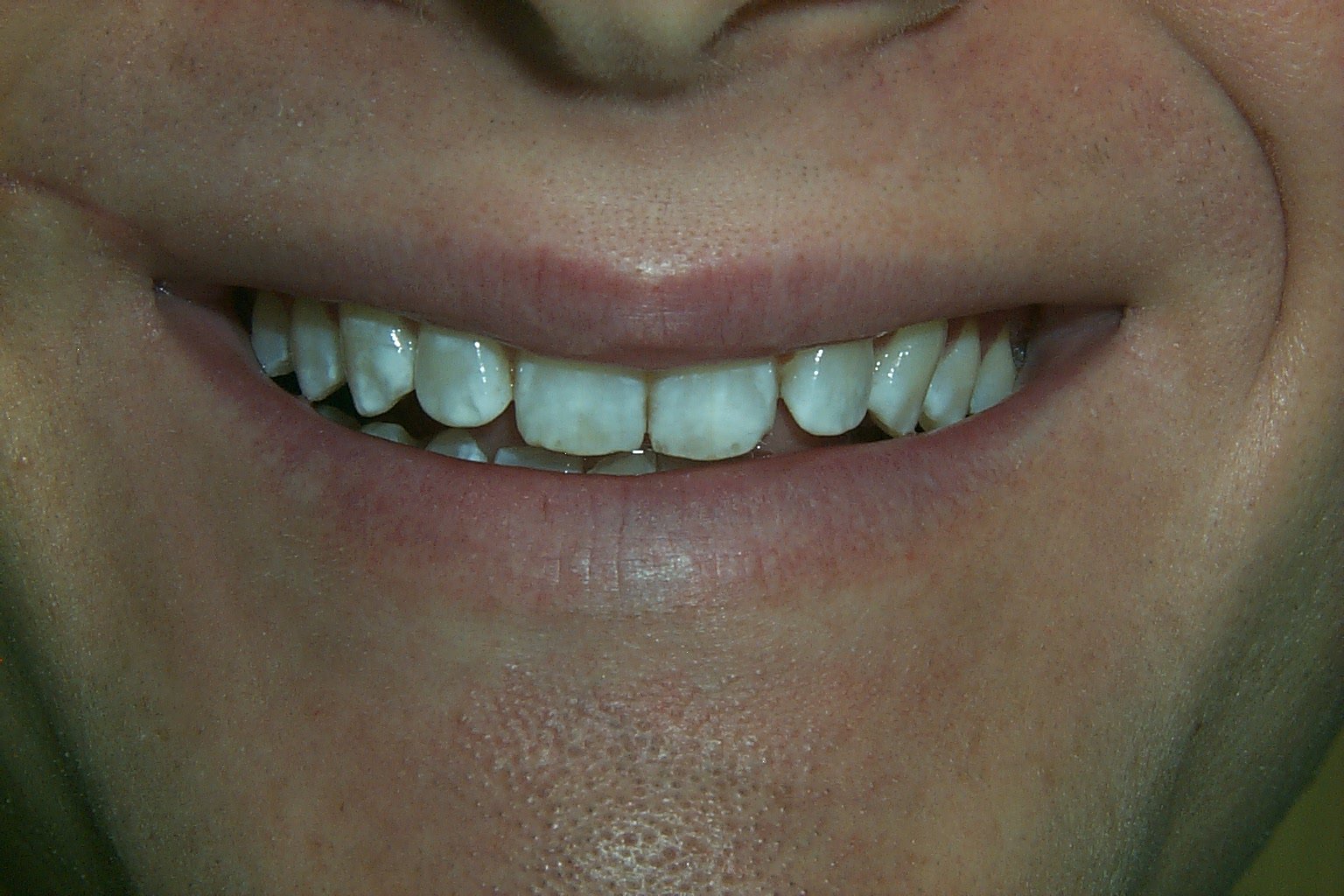Before Porcelain Veneers